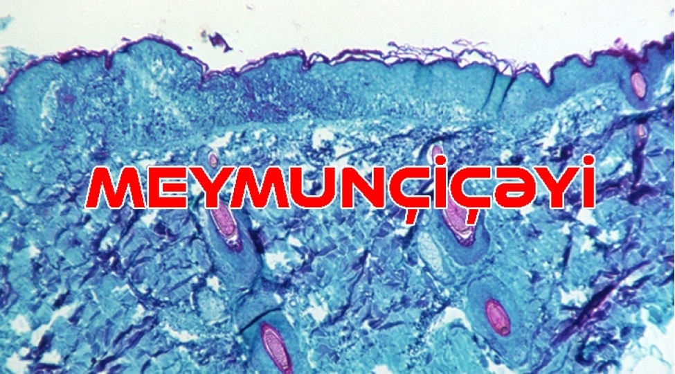 meymunchicheyi-virusuna-qarshi-tedbirler-guclendirilib