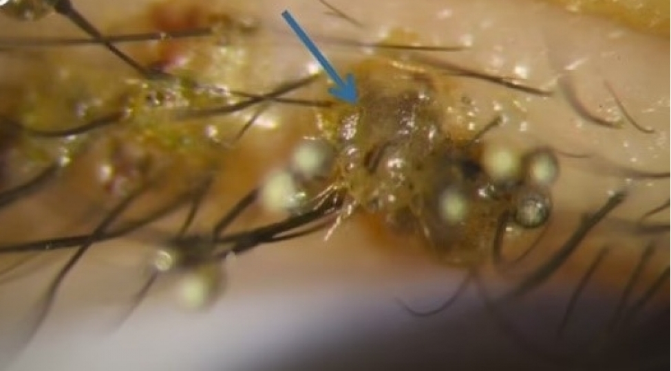 tibbde-nadir-gorunen-kiprik-biti