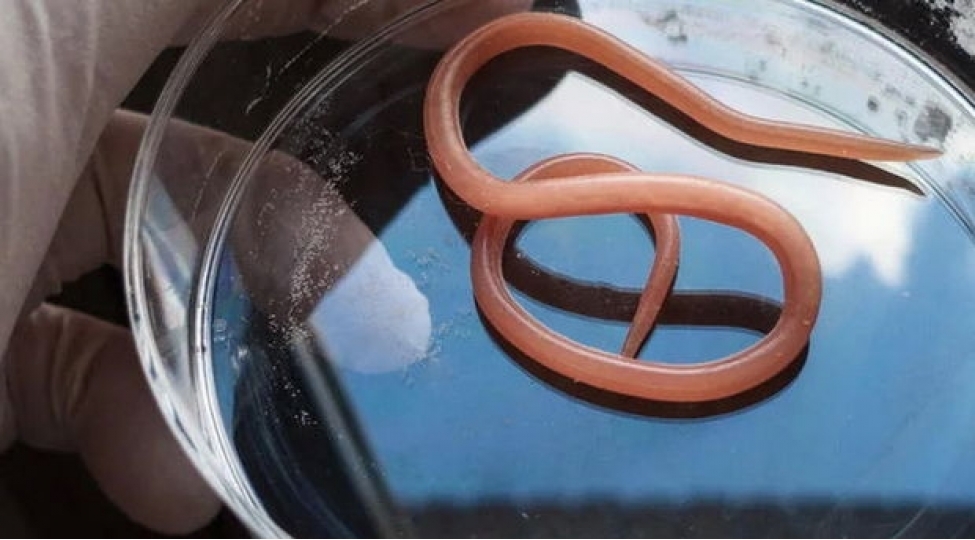 hekimler-qadinin-beyninden-soxulcan-chixardilar-hem-pasiyent-hem-de-qurd-sagdir