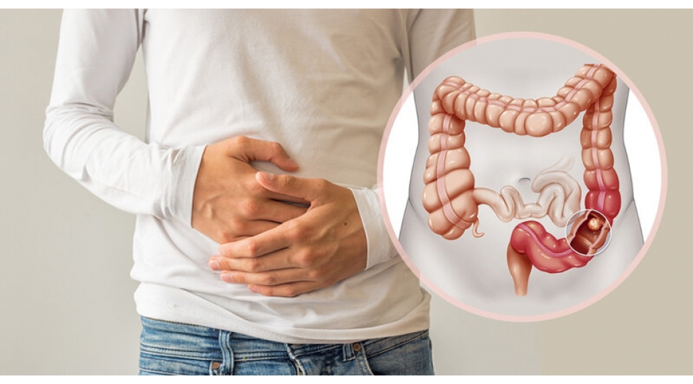 kolon-xerchengi-riski-niye-artir